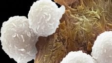 توقعات بزيادة الإصابات بالسرطان حول العالم بحلول 2050