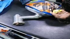 كادر مستشفى القائم بالانبار يتمكن من انقاذ طفل علقت يده في فرامة لحم.