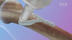 “ثورة في طب العظام” .. استطاع علماء من الصين إبتكار لاصقًا طبيًا يستطيع إصلاح الكسور في العظام خلال “ثلاث دقائق فقط”