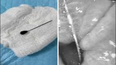 استخراج “دبوس حجاب” من معدة مريضة تبلغ من العمر 15 عاماً في مستشفى الكندي ببغداد.