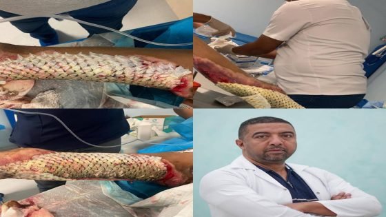 إجراء عملية نوعية لمريض يعاني من حروق بنسبة 45% باستخدام جلد السمك كبديل للترقيع الجلدي في ميسان