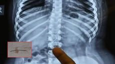 فريق طبي في محافظة ميسان ينجح في استخراج “إبرة خياطة” من معدة طفل بعمر 9 سنوات.