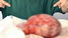 أطباء في مستشفى بأربيل يتمكنون من إزالة عقدة بوزن 4.4 كغم من رحم مريضة بعمر 39 عاماً.