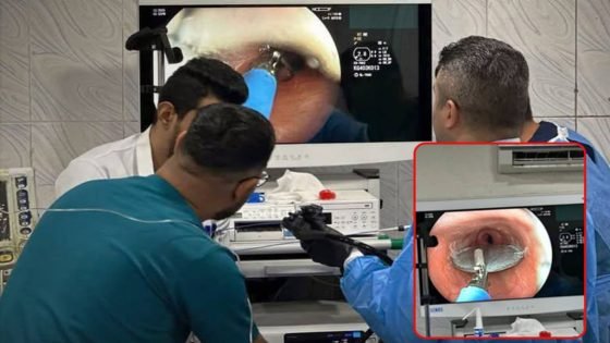 فريق طبي في ديالى يجري عملية طارئة لطفل بعمر 9 سنوات لاستخراج قطعة معدنية من جسمه.